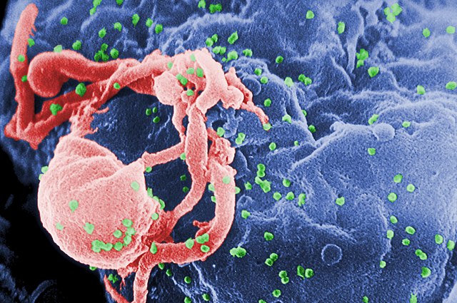 Scanning electron micrograph of HIV-1 budding (in green) from cultured lymphocyte. This image has been colored to highlight important features. Multiple round bumps on cell surface represent sites of assembly and budding of virions. (Image/WikiCommons)